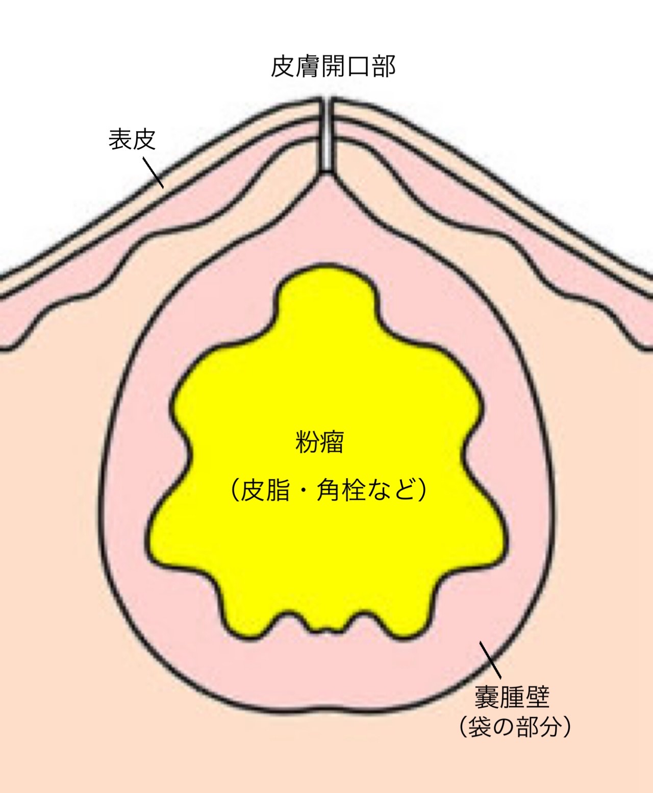 粉瘤（アテローム）手術